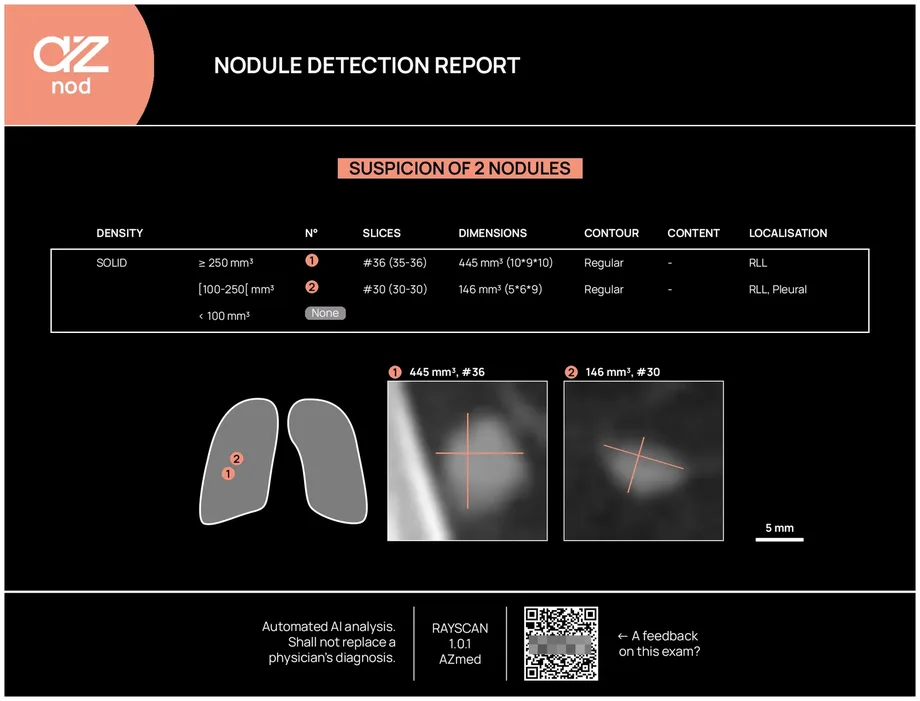 Sample AZnod nodule detection report, showing detected nodules, measurements, and lung location